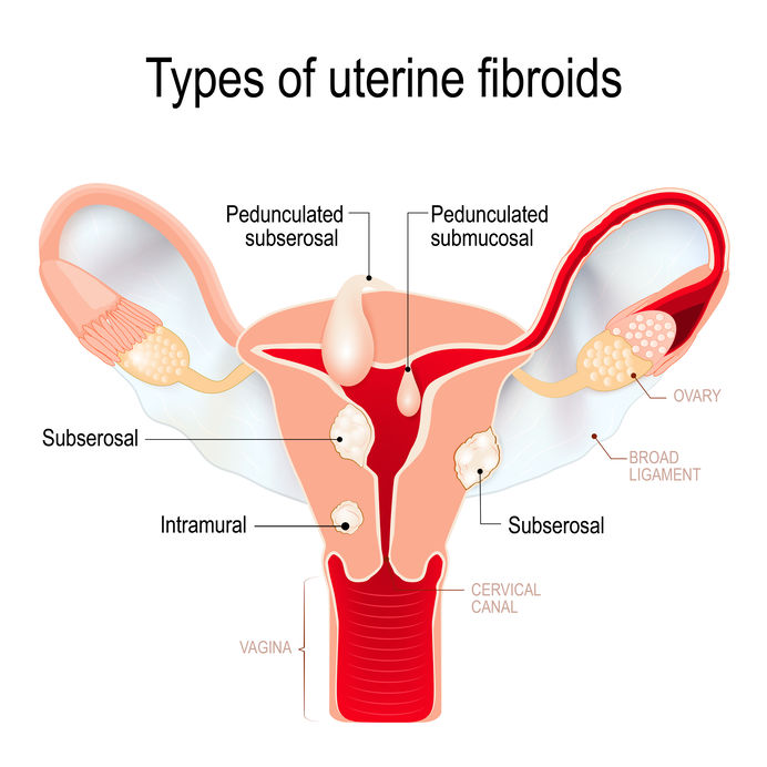 Types of Uterine Fibroids