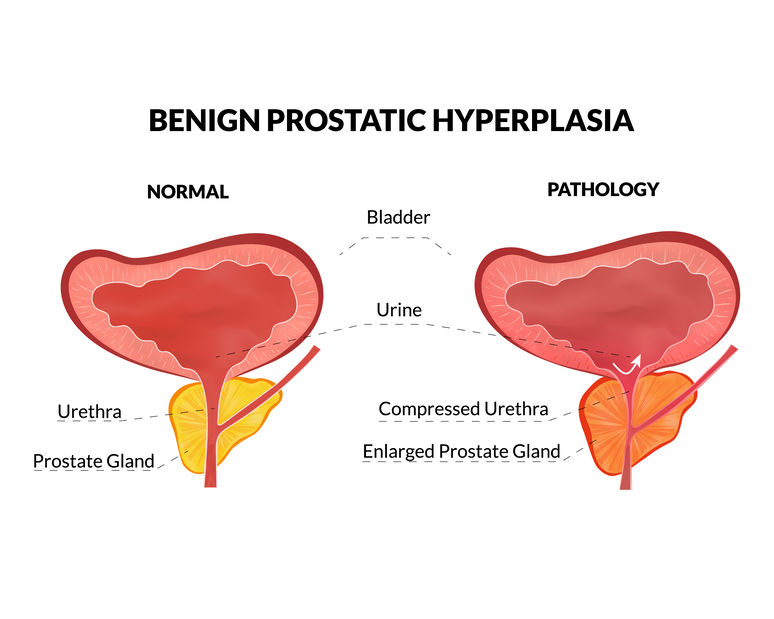 Prostate Enlargement (Benign prostatic hyperplasia)