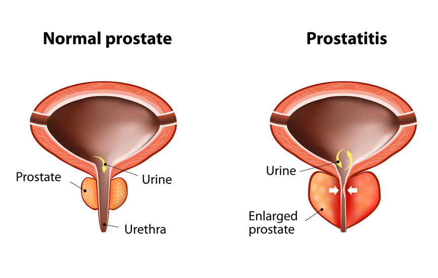 Normal Prostate Vs Enlarged Prostate