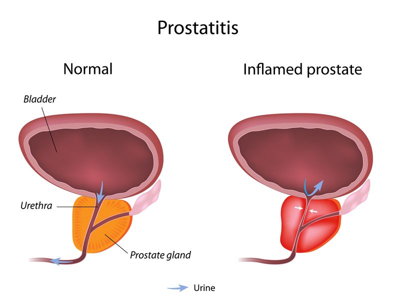 Chronic Bacterial Prostatitis
