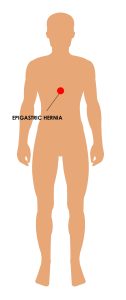 Representation of Epigastric hernia in human