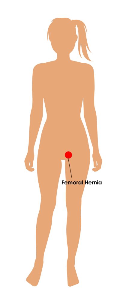 Representation of Femoral Hernia