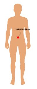 Representation of Umbilical Hernia in adult male