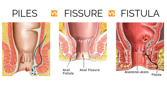 Piles, Fissure, Fistula