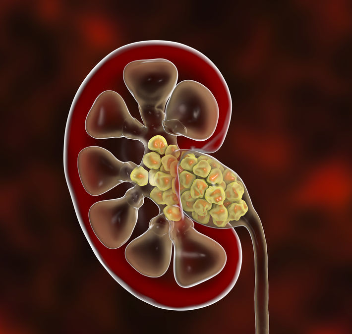 Kidney Stones: A Detailed Understanding