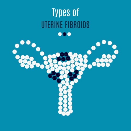 Types of Uterine Fibroids: Things you need to know about them