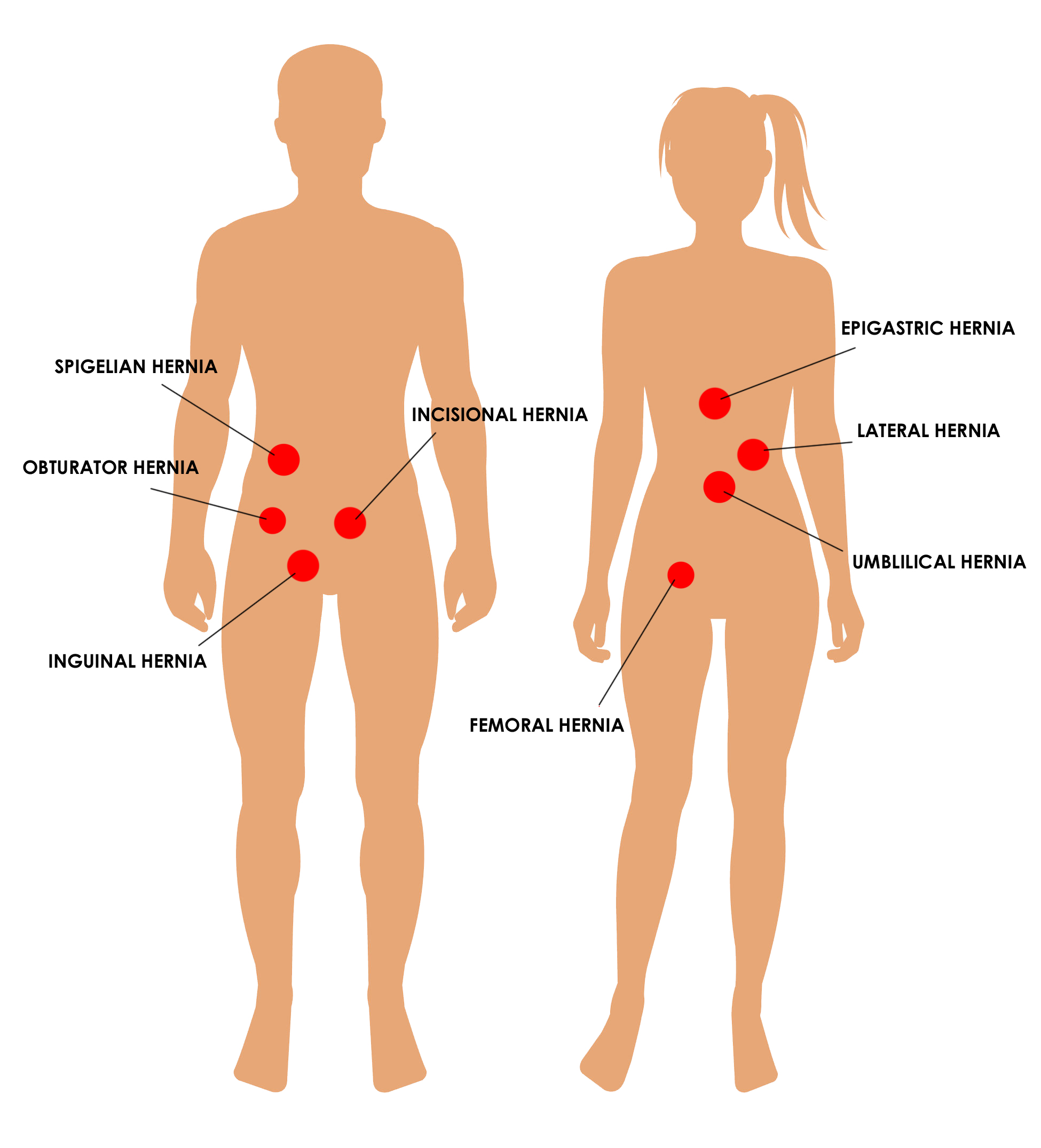Representation of types of hernia