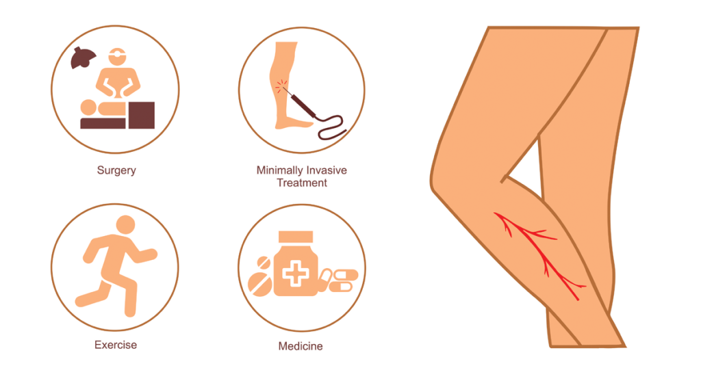 An Image showing varicose veins, surgery for it, laser treatment, medicine and exercises.