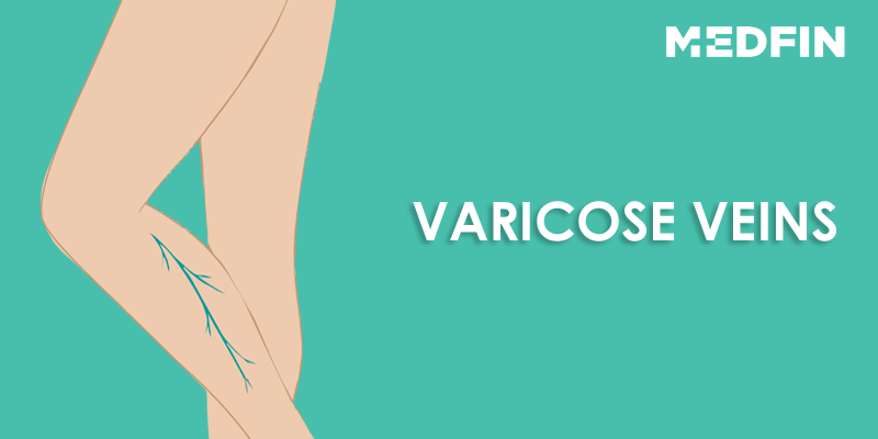 Should_I_be_concerned_about_varicose_veins?