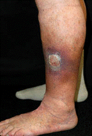 Ulcers: Varicose Veins (Stage 4)