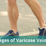 Stages_of_Varicose_Veins