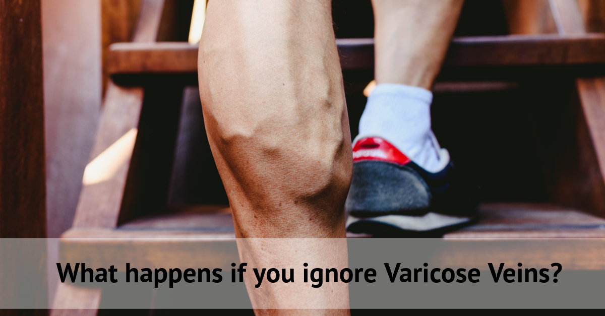 What happens if you ignore varicose vein?