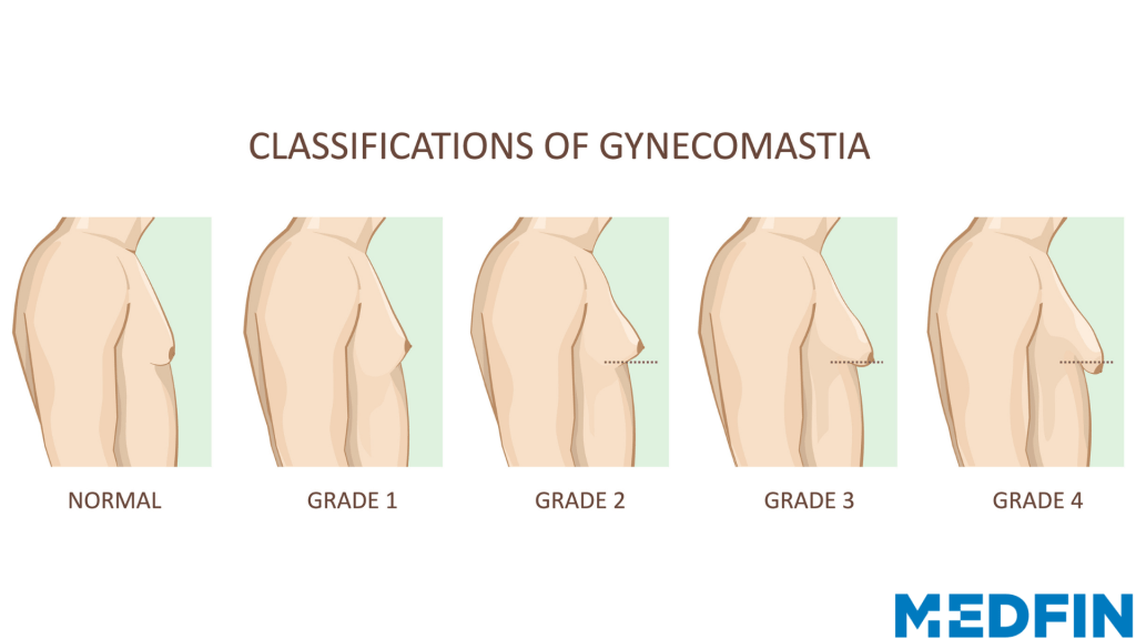 Gynecomastia classification