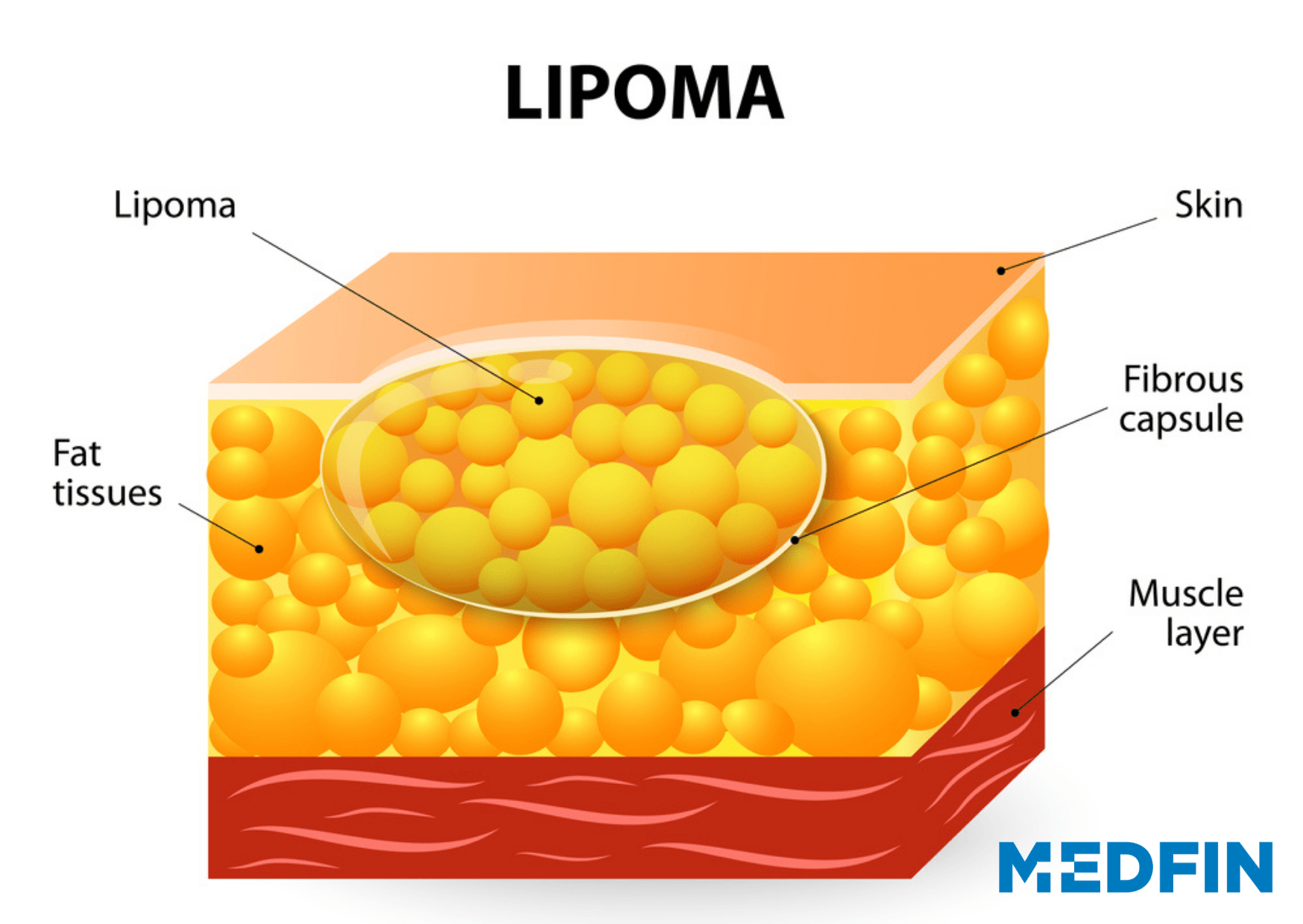 Why do Lipomas occur?