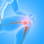how long does a artificial knee last